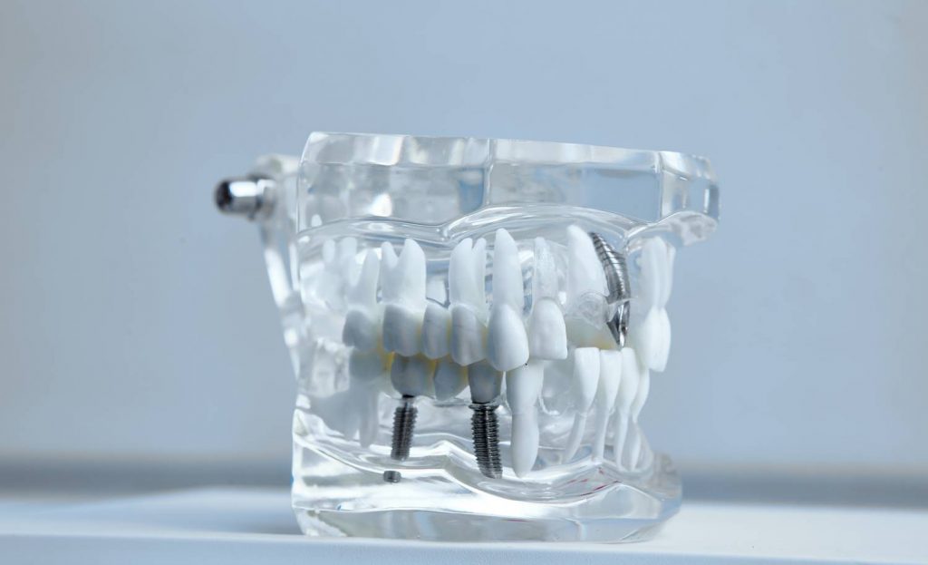Implanty zębów z Warszawy