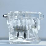 Implanty zębów z Warszawy