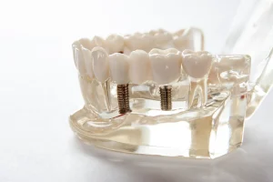 Implanty zębów w Szczecinie